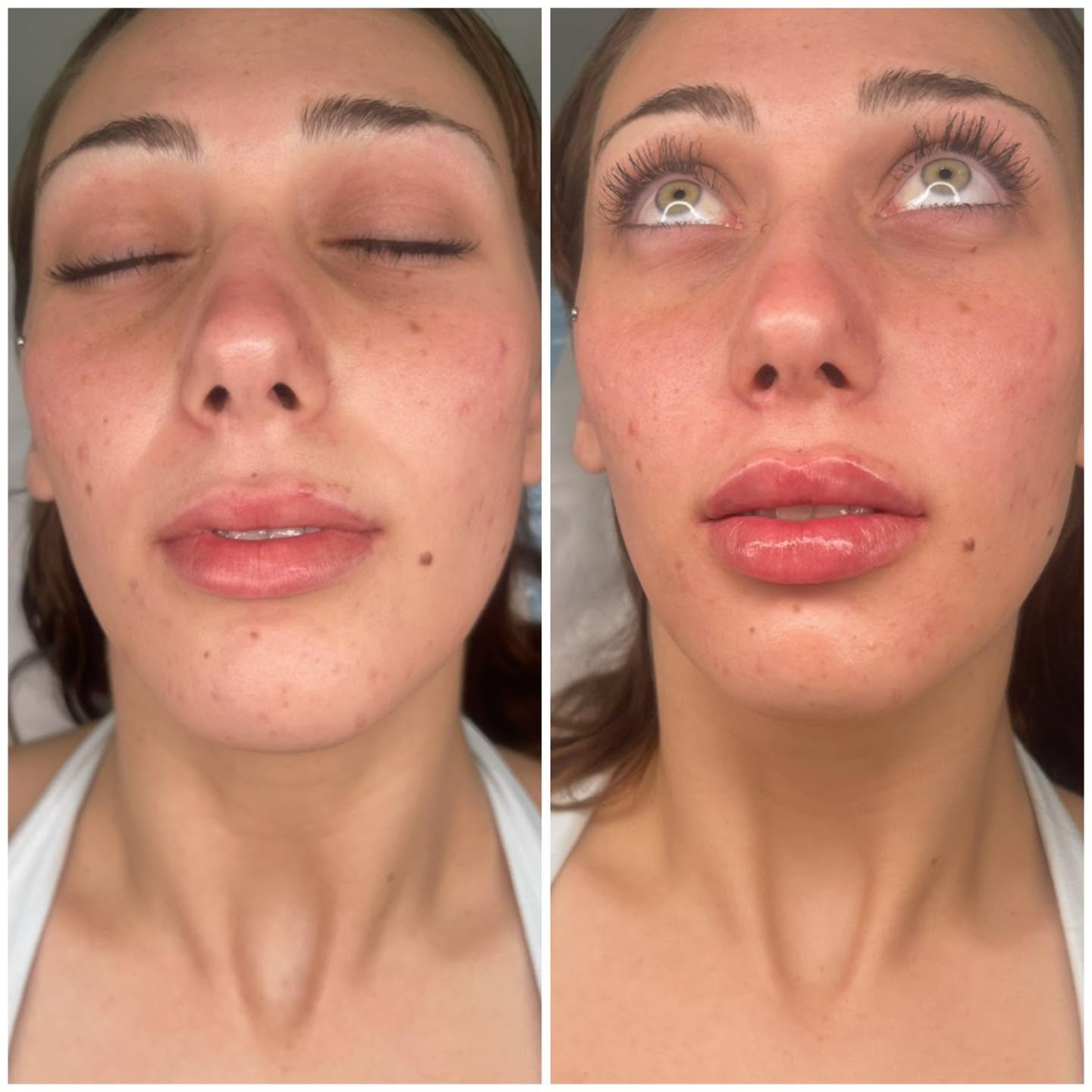 Before and after photograph of lip volume and border definition, Surfers Paradise