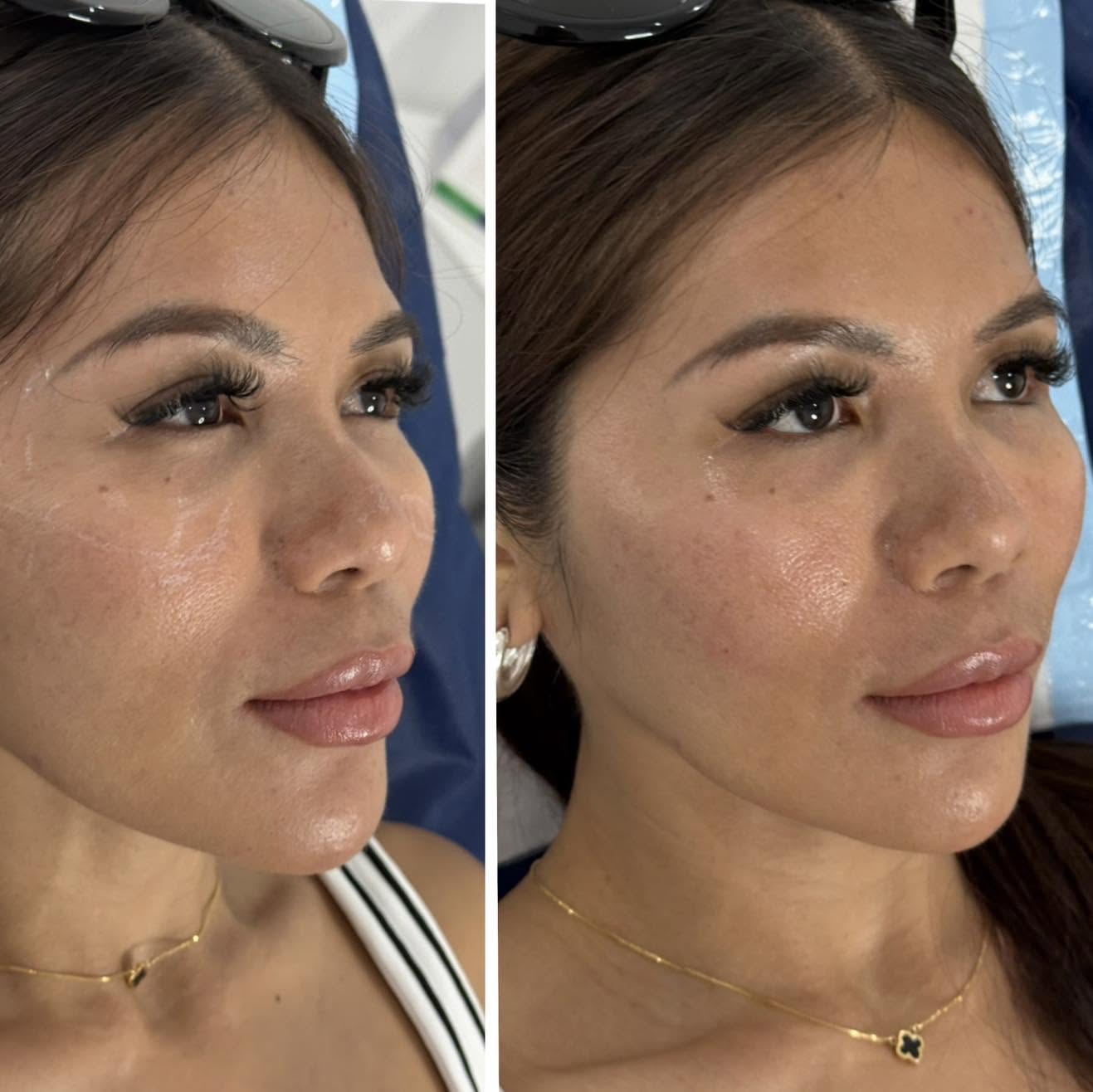 Before and after photograph of improved skin clarity and pigmentation, Surfers Paradise clinic