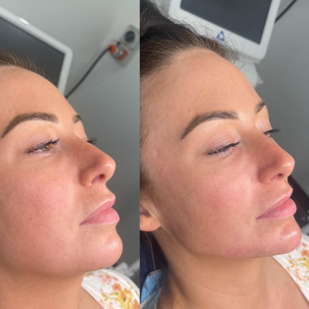Profile before and after photograph of chin and jawline definition, Gold Coast