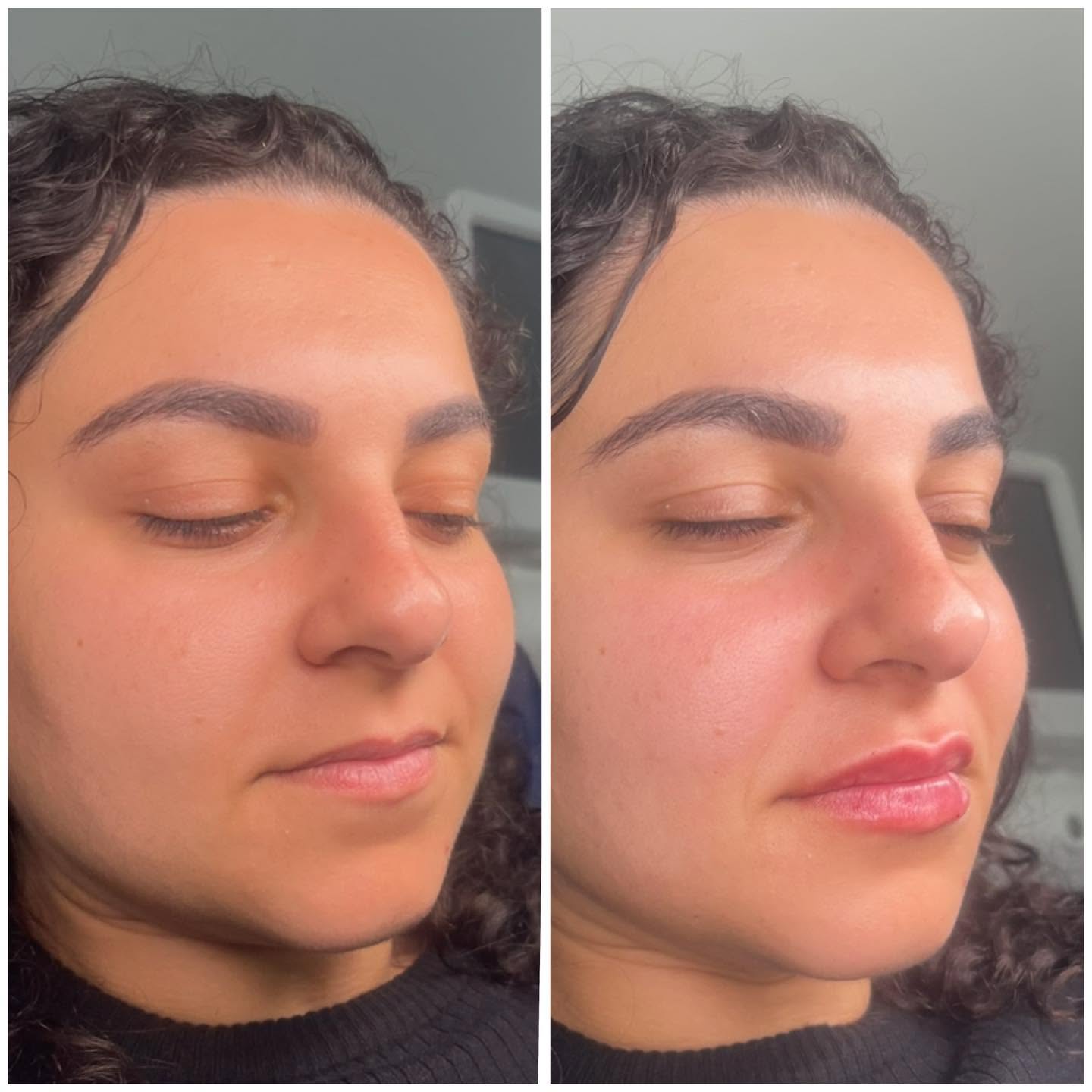 Three-quarter view before and after photograph of lip balance at a Gold Coast cosmetic clinic