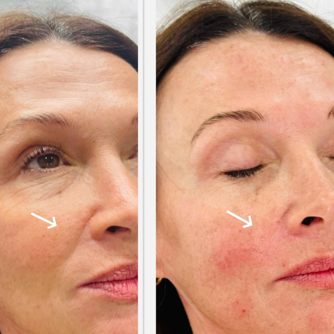 Before and after photograph of under-eye hollowing and mid-face refresh, Surfers Paradise