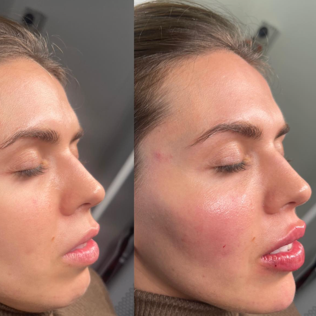 Before and after photograph of facial contour and cheek volume, Surfers Paradise cosmetic clinic