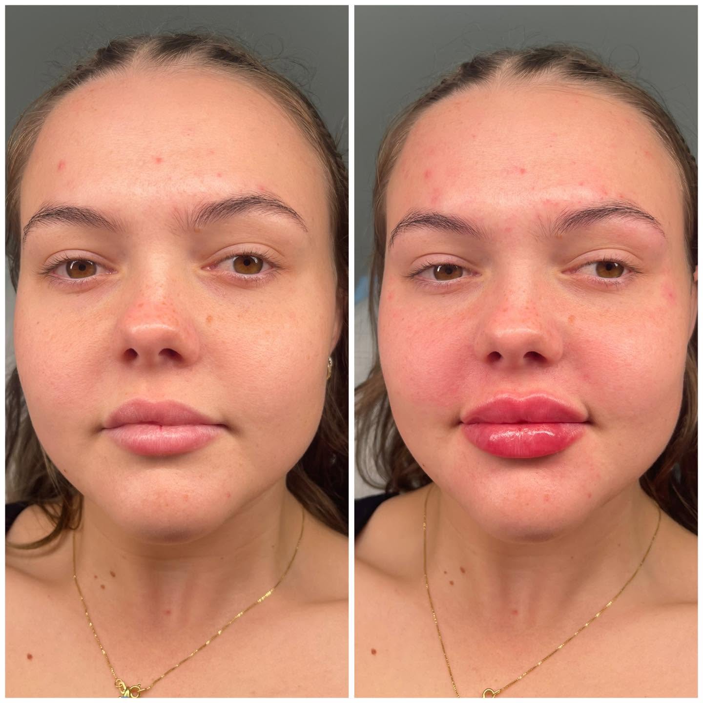 Front-facing before and after photograph of lip hydration and shape at All About Face Aesthetics, Surfers Paradise