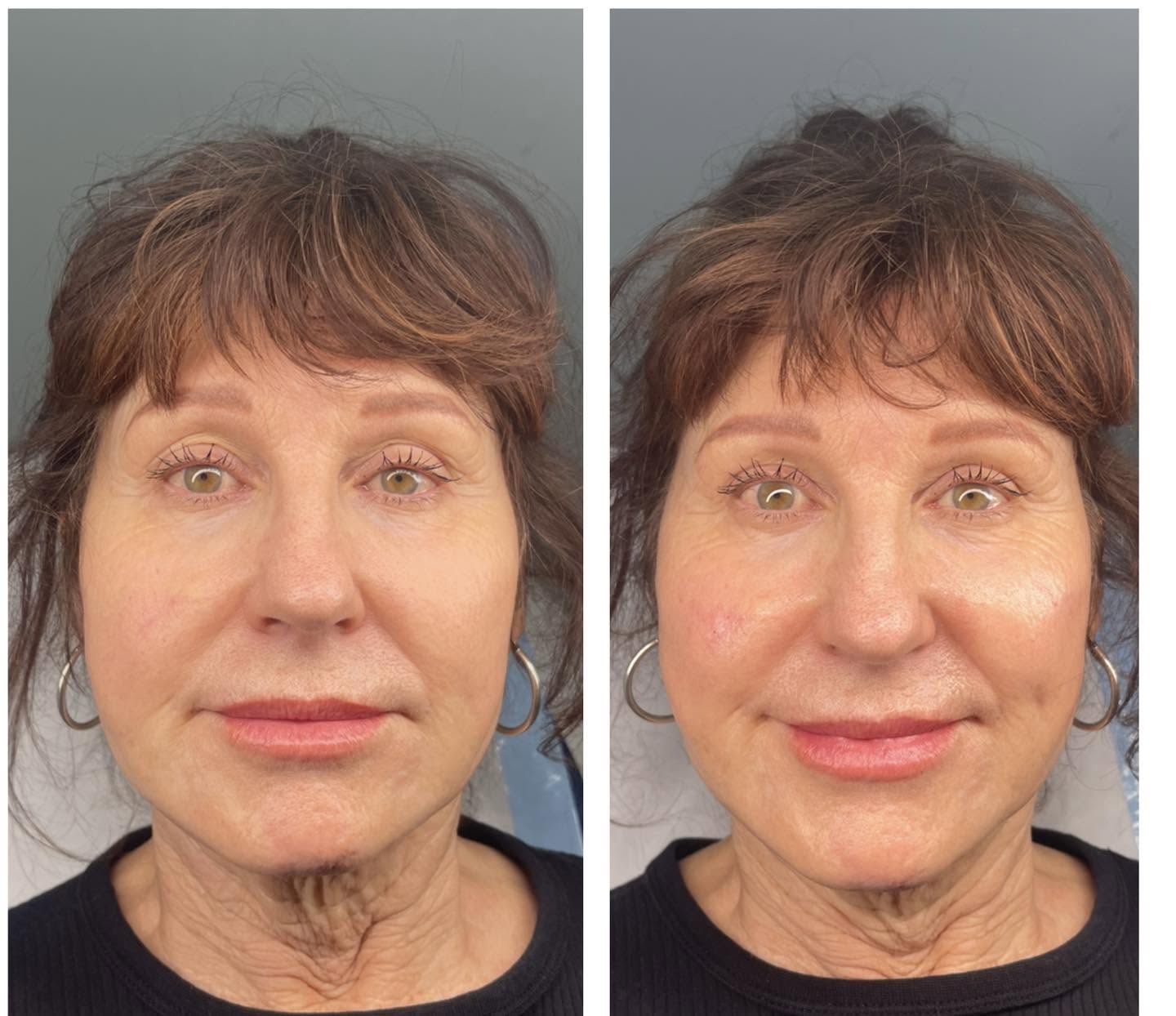 Before and after photograph of facial skin firmness and texture on mature skin, Gold Coast