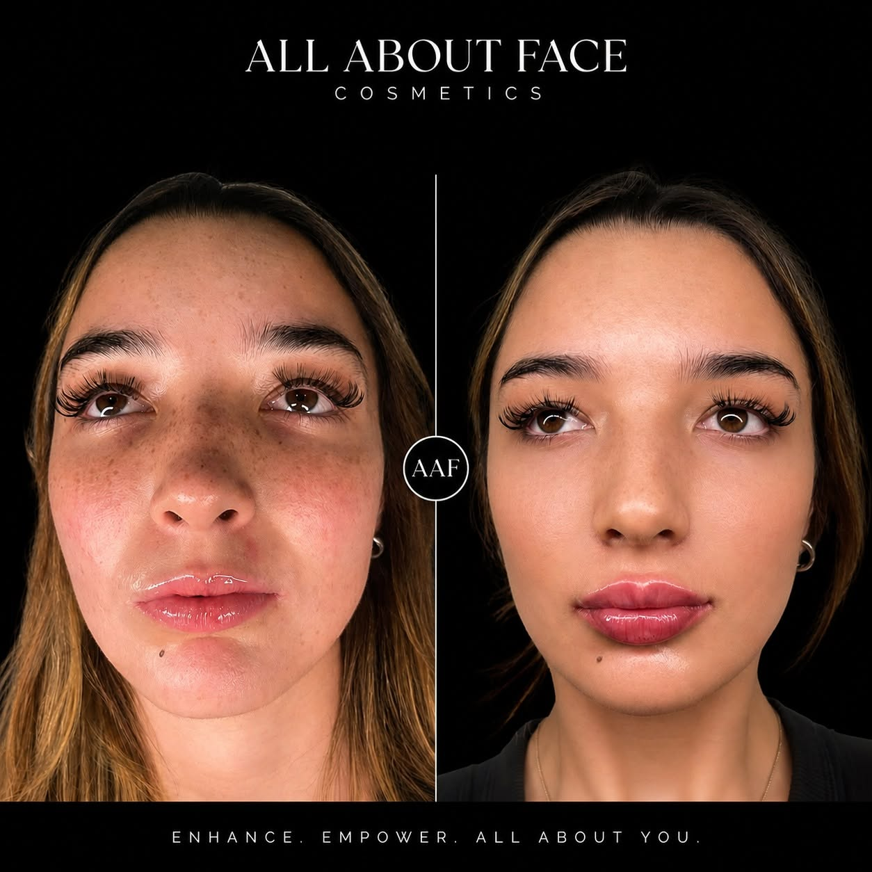 Before and after photograph of skin tone and lip definition at All About Face Aesthetics, Surfers Paradise