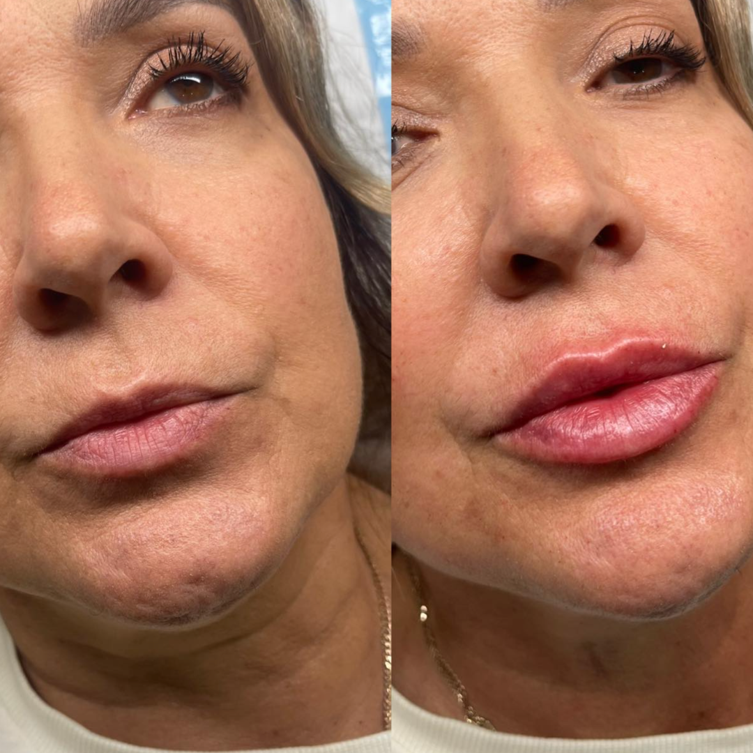 Before and after photograph of lip definition at All About Face Aesthetics, Gold Coast