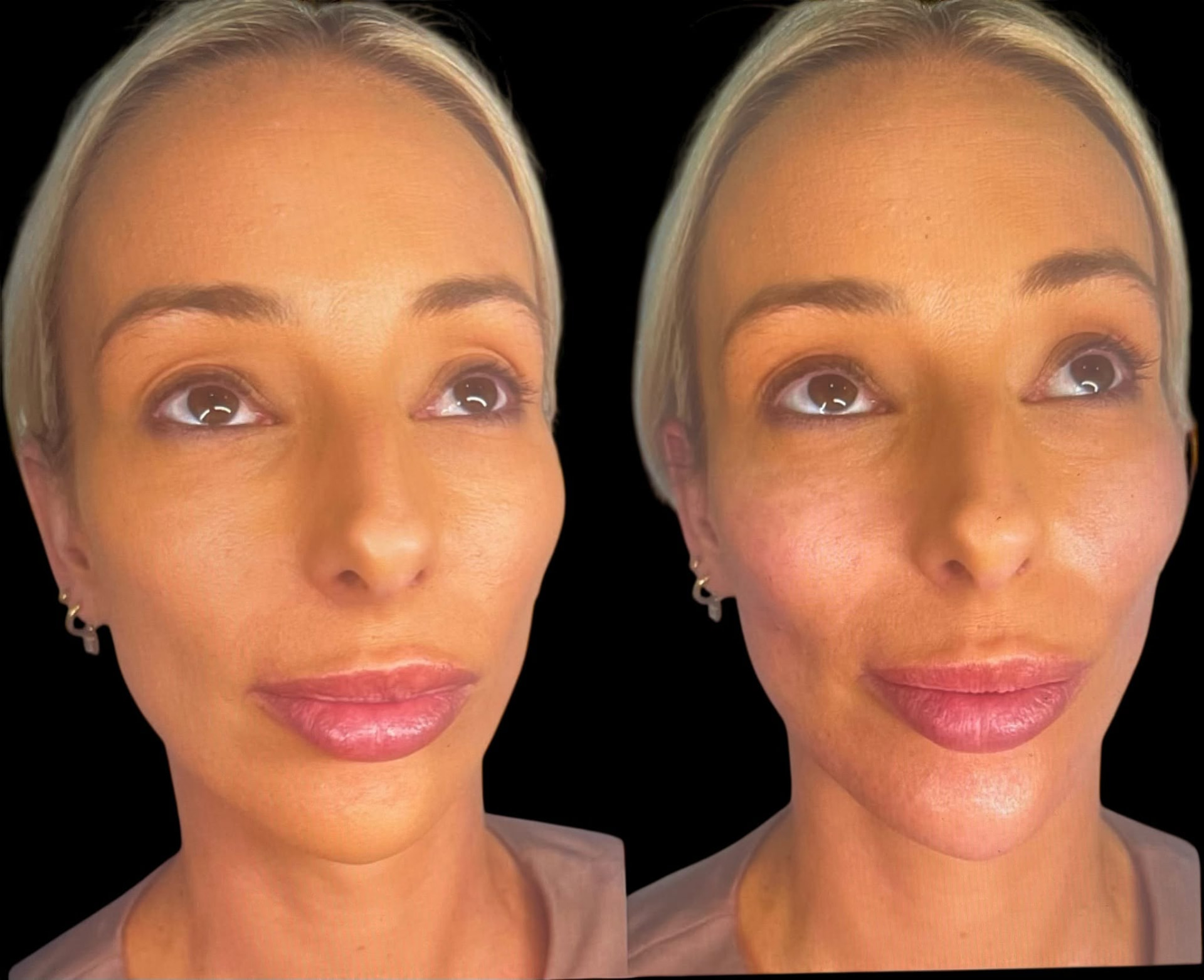 Before and after photograph of lower-face support and contour at All About Face Aesthetics